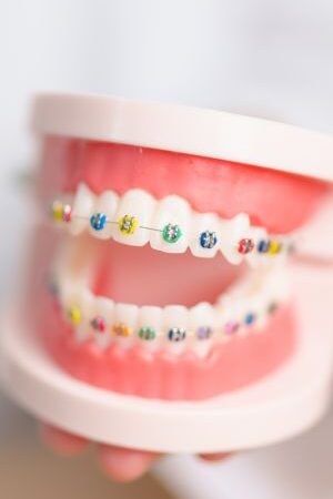 Ceramic braces Ceramic braces