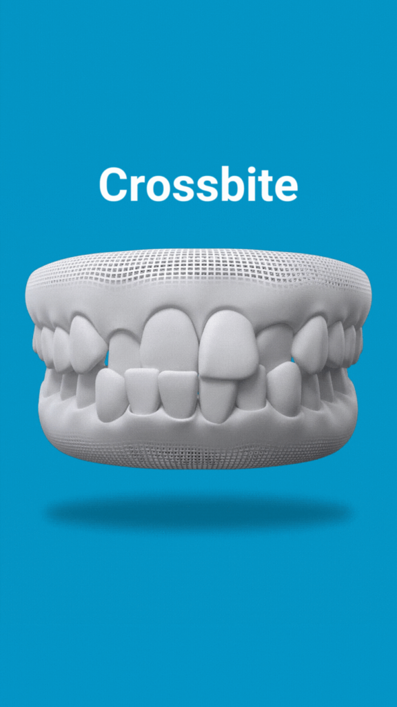 Invisalign corrects crossbite