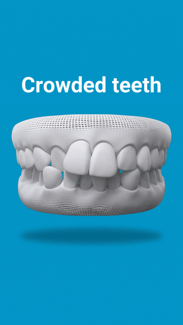 Invisalign corrects crowded teeth