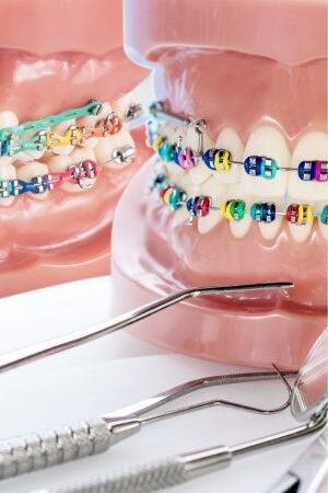 Metal_braces Metal_braces