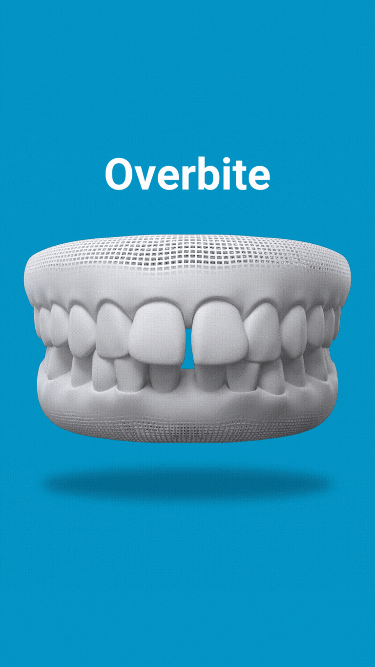 Invisalign corrects overbite
