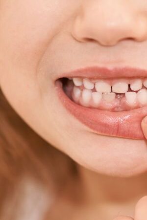 undercrowding undercrowding