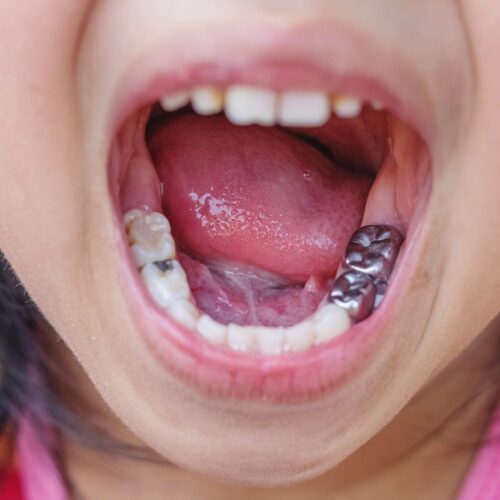 e79f8f08-a3f6-4f2e-ab29-53db675474ce stainless steel crowns for kids